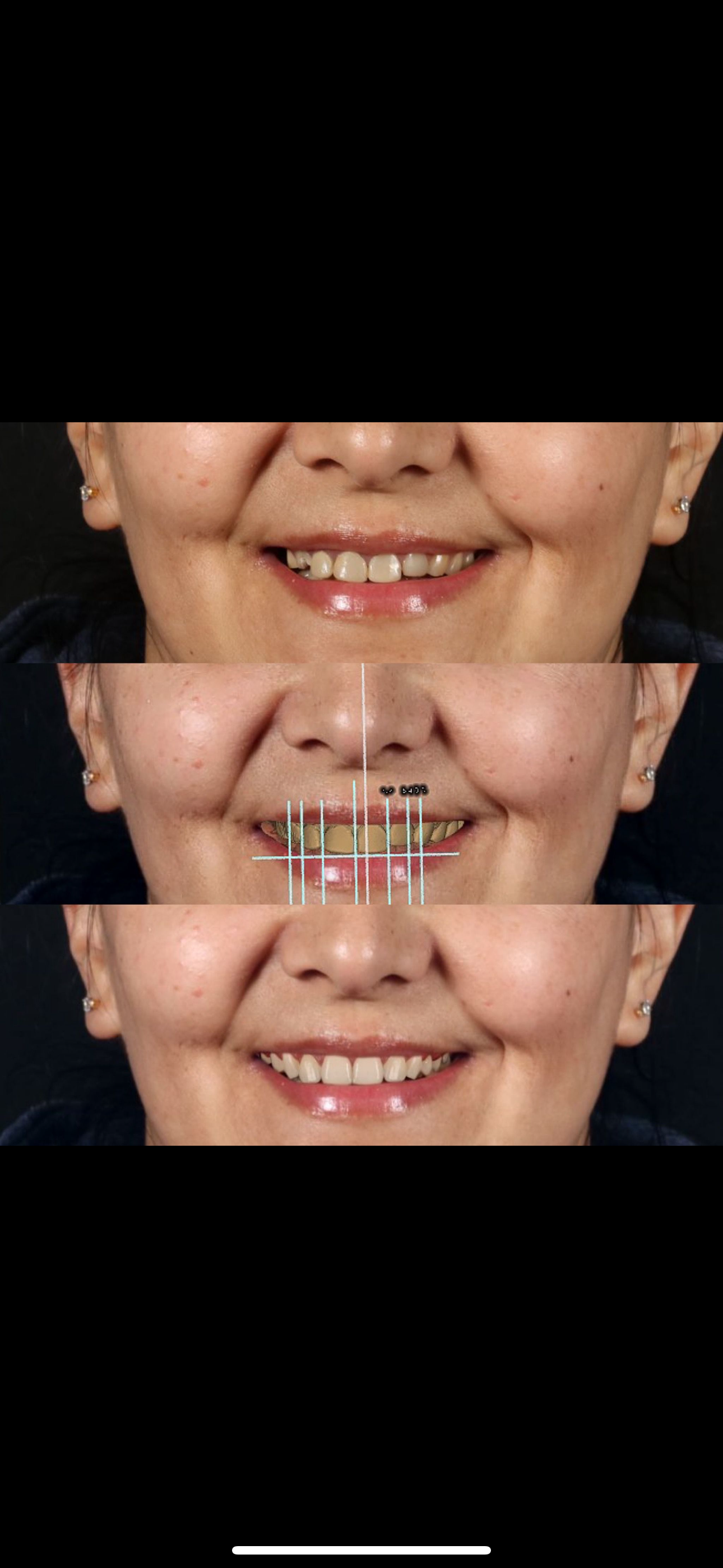 Diseño de sonrisa digital